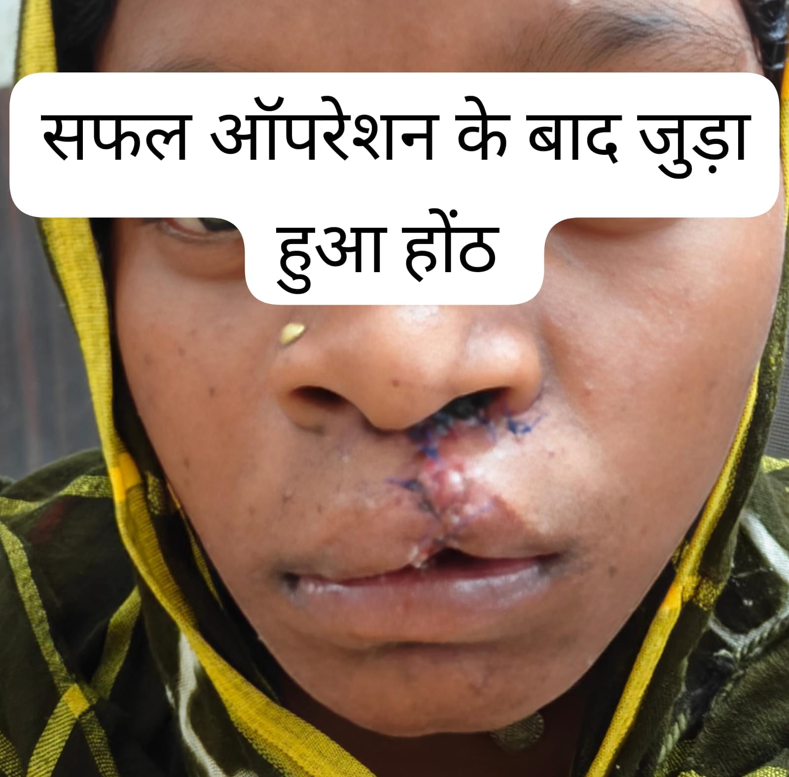 सफलता की कहानी : सफल सर्जरी से भीमे हेमला के चेहरे पर लौटी मुस्कान..